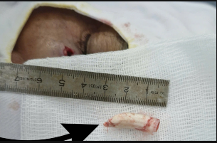 Cựa gà trống 2,8 cm đâm sâu vào mặt người đàn ông