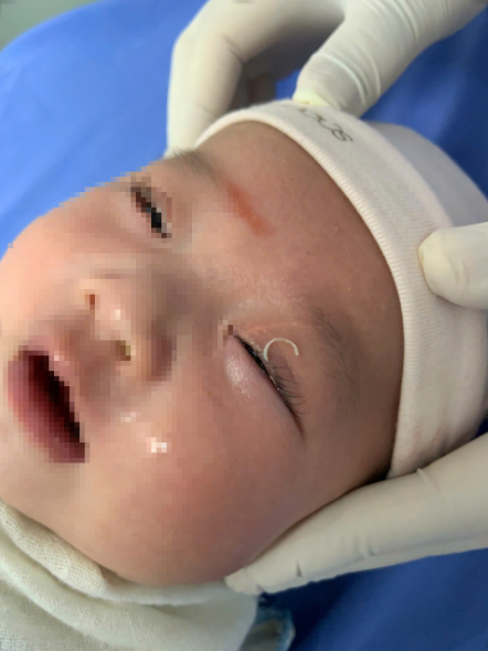 Hy hữu: Mẹ cắt móng tay khiến dị vật rơi vào mắt con 2 tháng tuổi