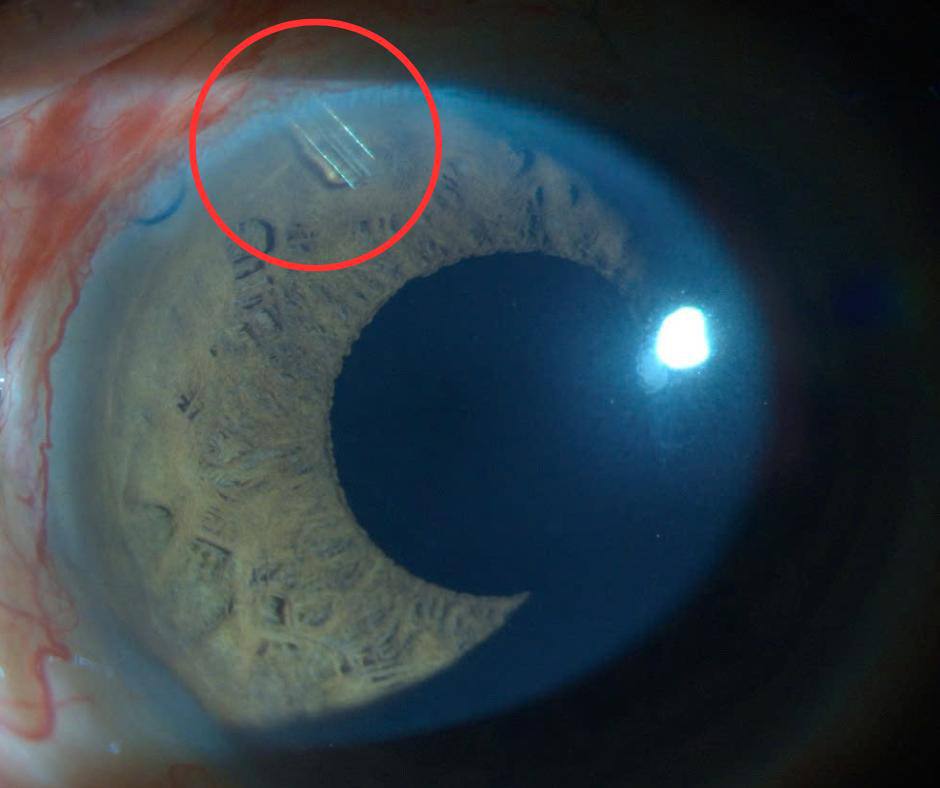 Tin vui: 3 bệnh viện áp dụng thành công phương pháp đặt PGI cho bệnh nhân Glaucoma nặng